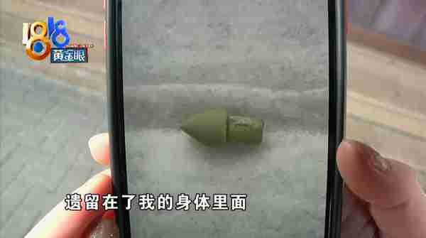 吸脂术探头留在姑娘体内,院方两次手术都没取出