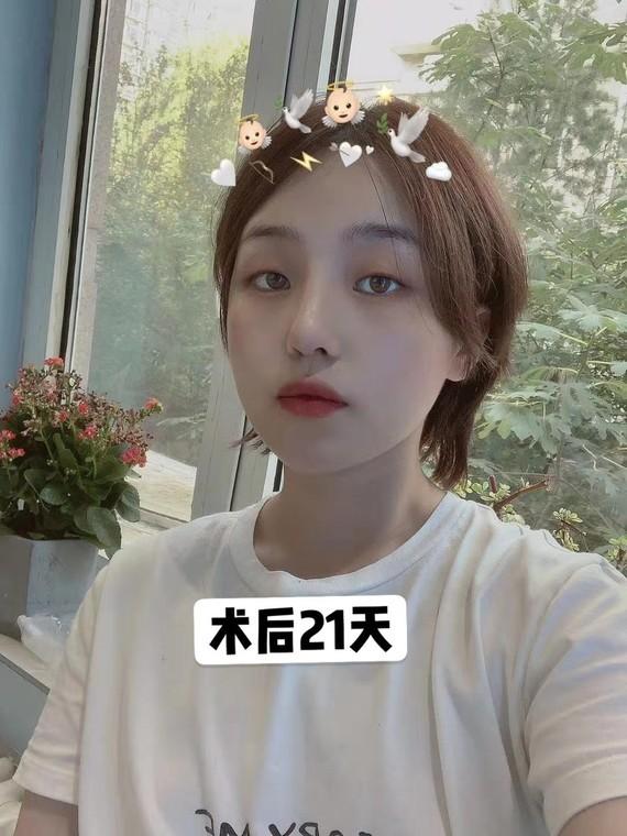韩国医生整形日记:半肋软骨鼻修复案例分享