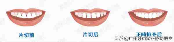 牙齿矫正的7大误区!别让这些耽误了矫正好时机