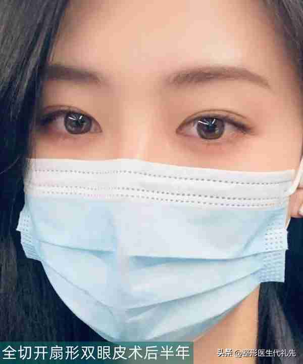 40岁来北京全切开扇形双眼皮,术后半年真实自然,气质180度提升