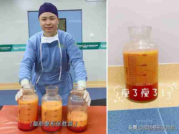 腰腹吸脂两个问题:术中需插尿管吗?术后影响怀孕吗?你了解一下