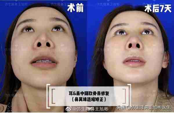 醒醒吧!L型假体隆鼻+耳软骨垫鼻尖,还在骗你是鼻综合
