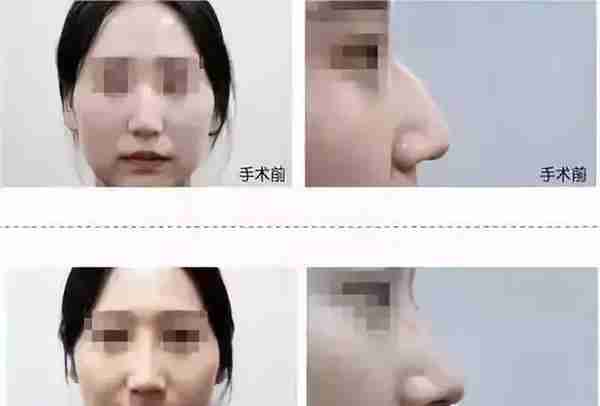 玻尿酸隆鼻VS线雕隆鼻