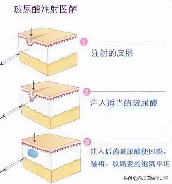 女明星都爱的美容宠儿:玻尿酸的作用与功效是什么?