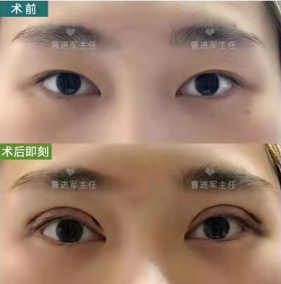 双眼皮的手术方法有哪些?