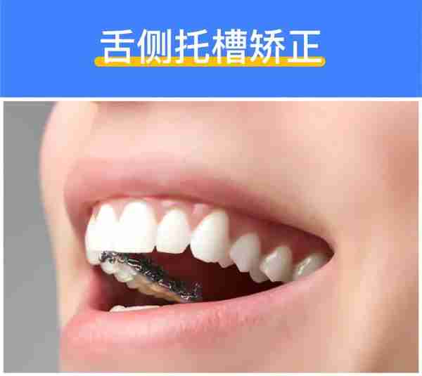 深度揭秘:牙齿矫正到底需要多少钱?