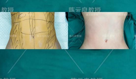 想全身吸脂怎么办?看完这篇你就知道专业吸脂医生是怎样规划的了