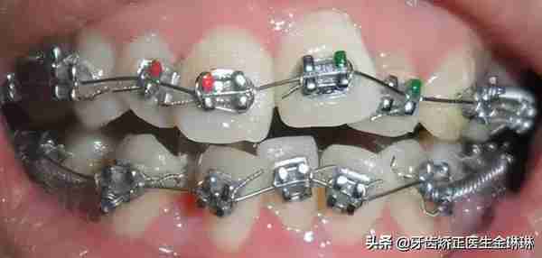 传统矫正、隐形矫正,哪个效果更好?