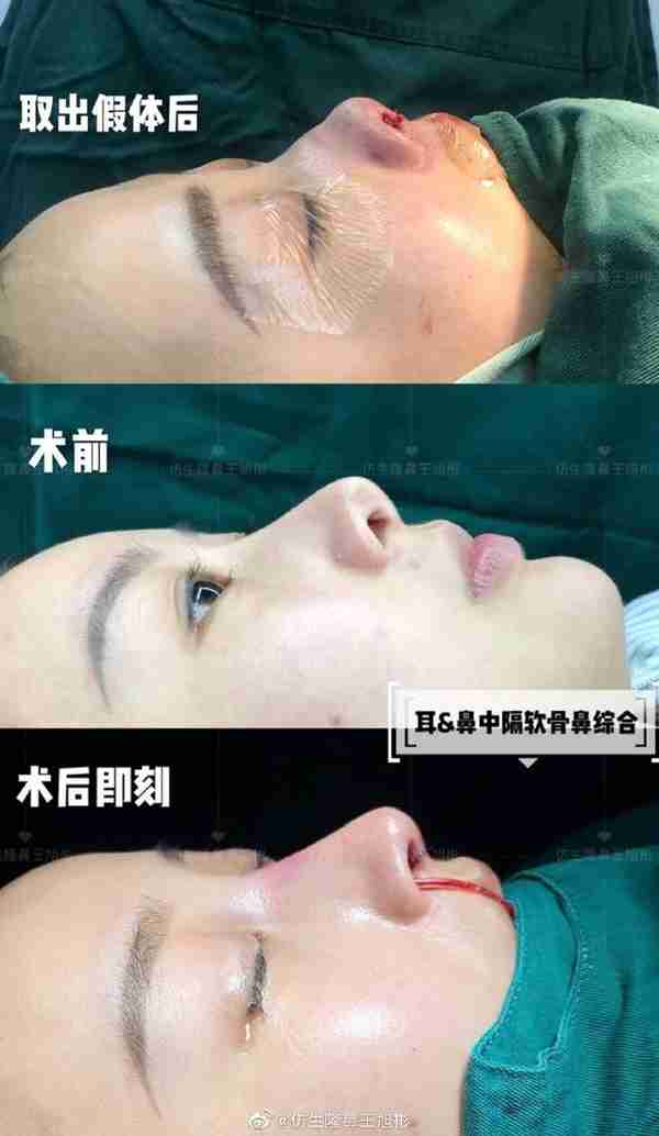 醒醒吧!L型假体隆鼻+耳软骨垫鼻尖,还在骗你是鼻综合