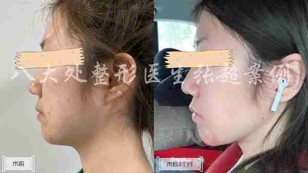 八大处张超面部吸脂反馈合集(五)