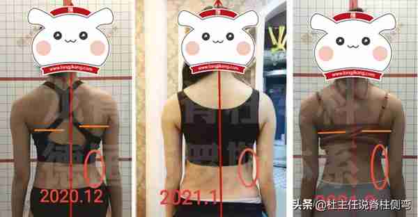 青少年特发性脊柱侧弯,可以做训练来减少侧弯度数的发展吗?