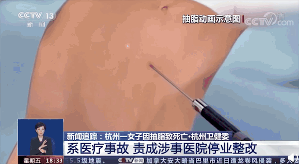 别轻易尝试!女子抽脂后去世,医生提醒→