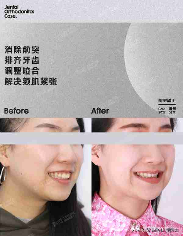 缺牙先别急着种!高性价比矫正案例,一次省去2颗种植费用