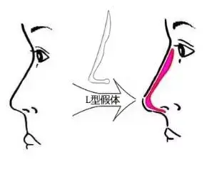注射隆鼻、线雕隆鼻、假体隆鼻、自体肋骨隆鼻,哪个适合你?