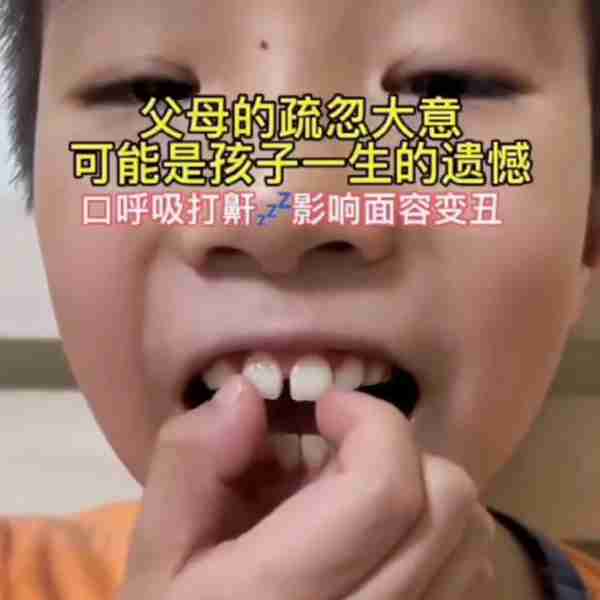 孩子张嘴睡觉要及时纠正 久了会变丑的哦,等牙齿凸了就...
