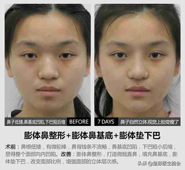 盘点3大类10种隆鼻材料,看看哪种最安全,效果保持最久?