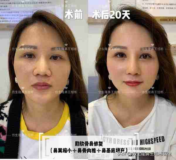 初鼻当心:硅胶假体隆鼻后,什么原因会造成包膜挛缩?可防可治吗