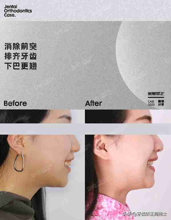 缺牙先别急着种!高性价比矫正案例,一次省去2颗种植费用