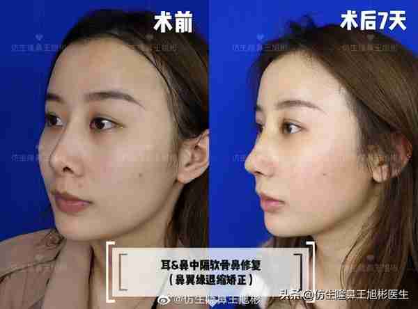 醒醒吧!L型假体隆鼻+耳软骨垫鼻尖,还在骗你是鼻综合