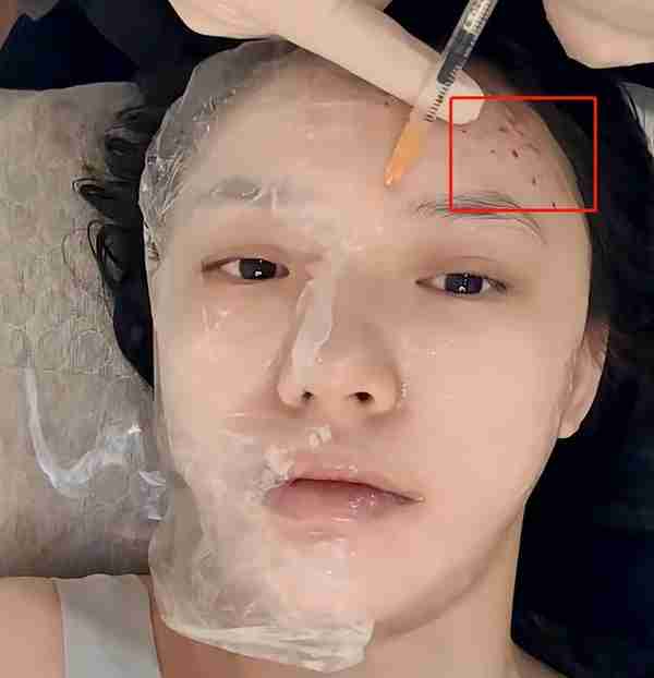 医美水光针、羊胎素盛行,一针58万却供不应求,明星渴望青春永驻