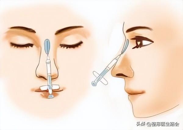 “玻尿酸隆鼻”是大热项目,简单快速,为什么我不建议大家做?