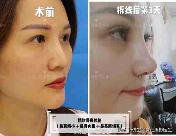 初鼻当心:硅胶假体隆鼻后,什么原因会造成包膜挛缩?可防可治吗