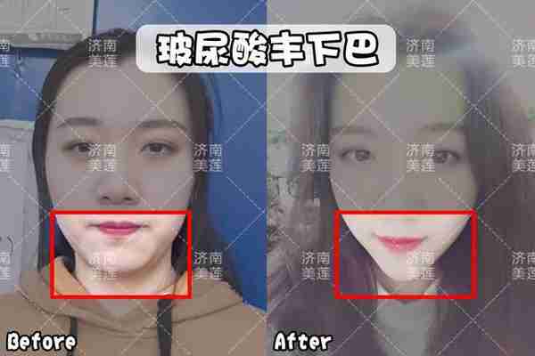 你知道你往脸上打的玻尿酸,是哪一类么?
