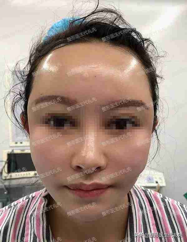 自体脂肪填充,哪里凹陷打哪里?也许不是你想像的那么简单
