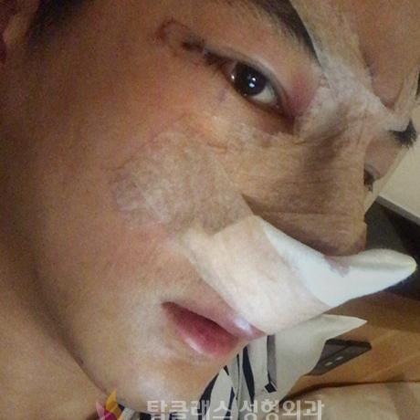 硅胶+鼻中隔+耳软骨男士隆鼻案例分享