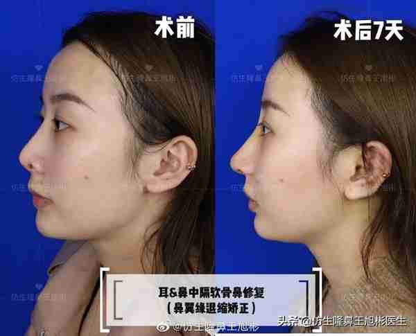 醒醒吧!L型假体隆鼻+耳软骨垫鼻尖,还在骗你是鼻综合
