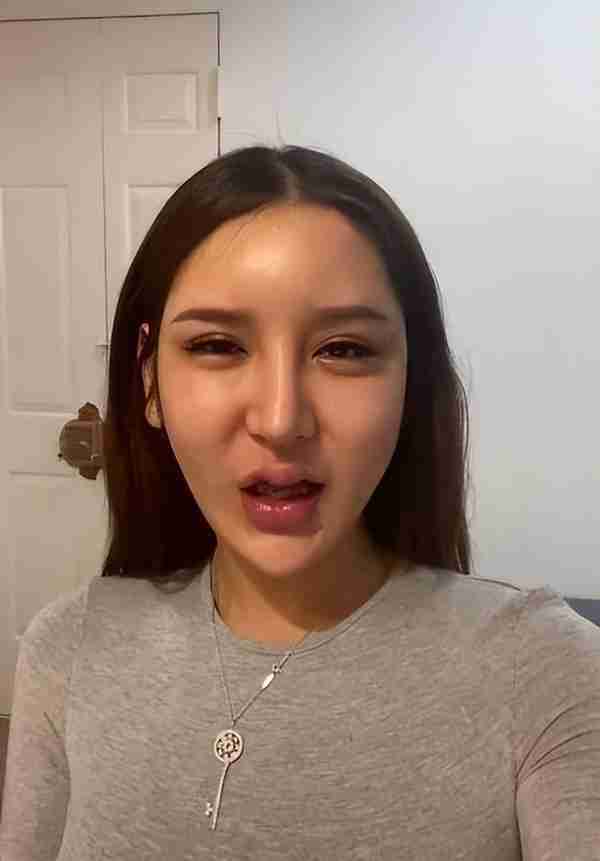 整容失败?网红脸内注射400多针玻尿酸:夏天会融化,冬天会冻住