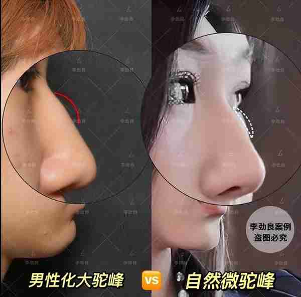 北京20岁女子被叫“大叔”,花6万做鼻子,术后换头,惊艳全家!