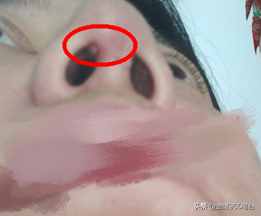 女子隆鼻半年后 变成了朝天鼻 不但红肿还渗液