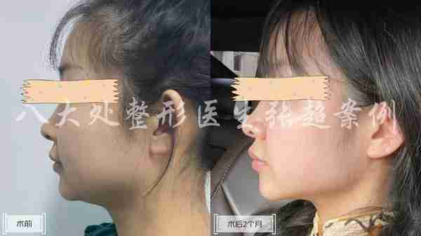 八大处张超面部吸脂反馈合集(五)