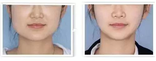 你适合打瘦脸针吗?