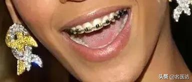 牙齿矫正没有年龄限制