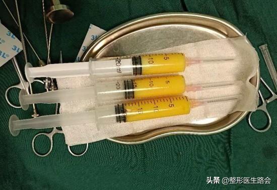 盘点3大类10种隆鼻材料,看看哪种最安全,效果保持最久?