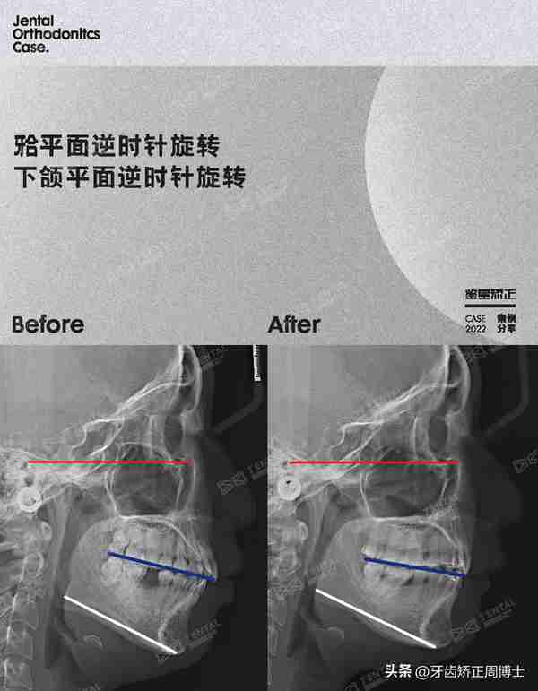 缺牙先别急着种!高性价比矫正案例,一次省去2颗种植费用