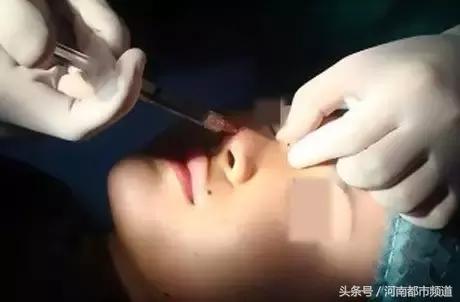 广州女子到朋友出租屋打了两针玻尿酸后,失明了!还有人脑梗全瘫