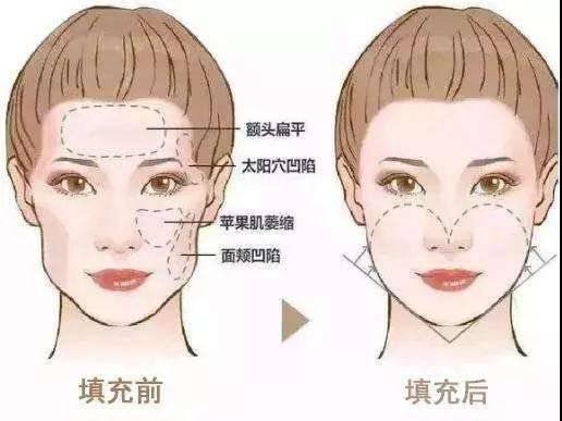不后悔篇:做“自体脂肪填充”之前,先看看这几个要点