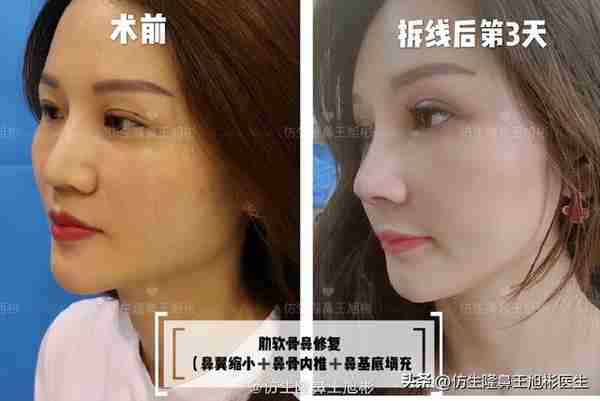 初鼻当心:硅胶假体隆鼻后,什么原因会造成包膜挛缩?可防可治吗
