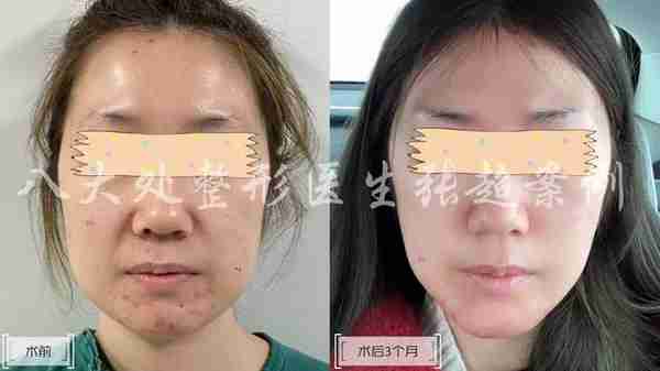 八大处张超面部吸脂反馈合集(五)
