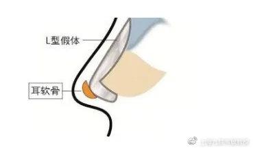 相比隆鼻,鼻综合其实更适合你