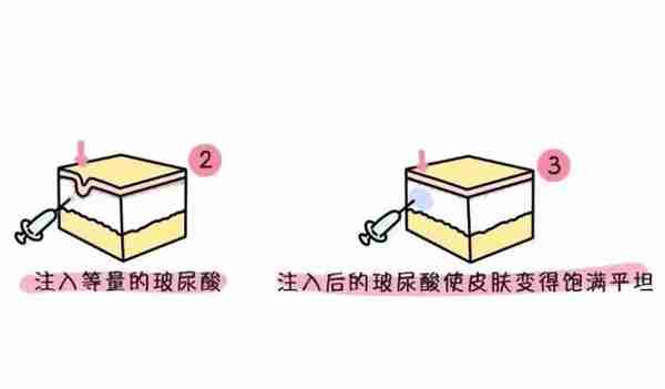 眼窝凹陷面露凶相?打了玻尿酸,眼睛好看,亲和力满满!