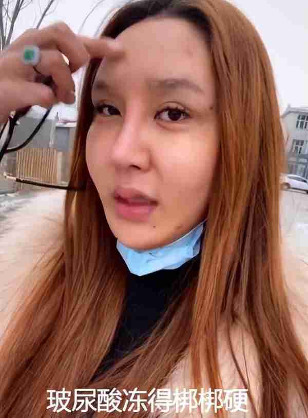 整容失败?网红脸内注射400多针玻尿酸:夏天会融化,冬天会冻住