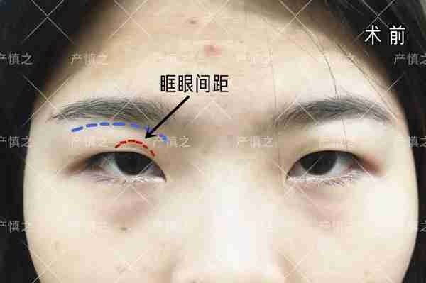 双眼皮是想做多宽就能做多宽吗?
