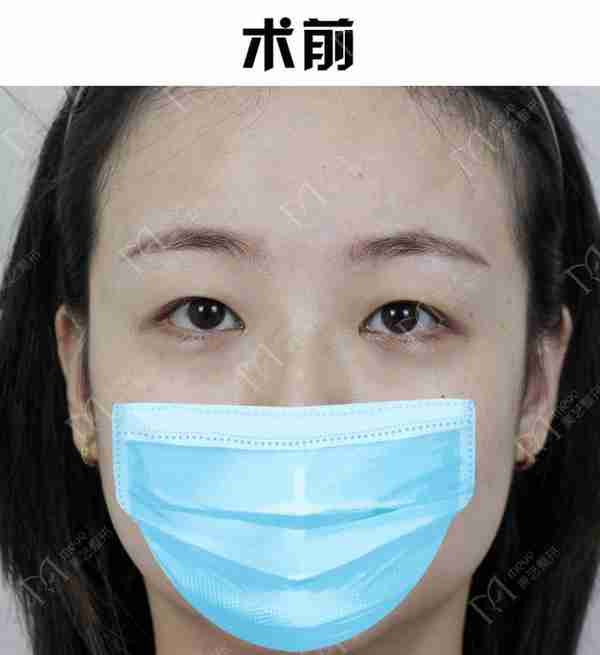 双眼皮想要内双变外双,不是说通过双眼皮就可以改善的