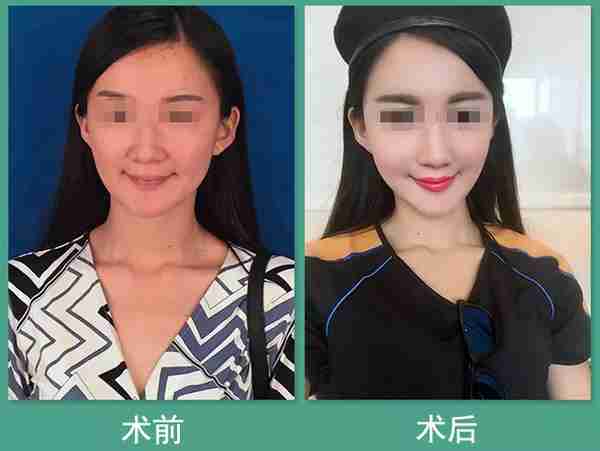自体脂肪“面部填充”,一次解决五大“面部问题”...