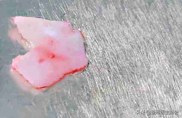 盘点3大类10种隆鼻材料,看看哪种最安全,效果保持最久?