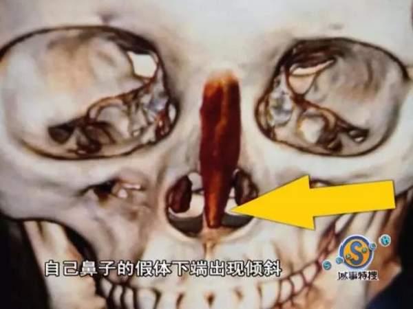 女子花9万元整容结果鼻子歪了 院方人员:去跳楼啊